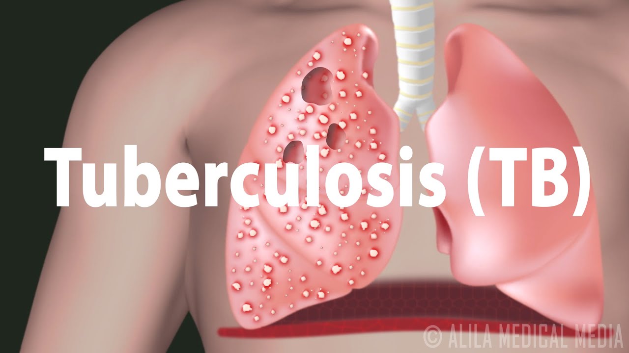結核病 疾病的發展 潛伏和活動性感染 Tuberculosis Tb Progression Of The Disease Latent And Active Infections Voicetube 看影片學英語